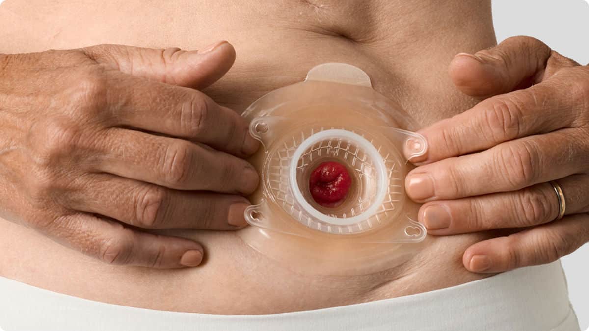 Viele Menschen mit einer Urostomie können von einer konvexen Versorgung profitieren