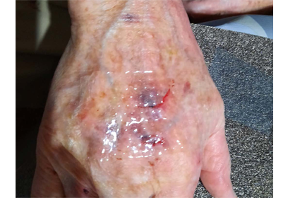 Skin Tears Behandlung Tag 1