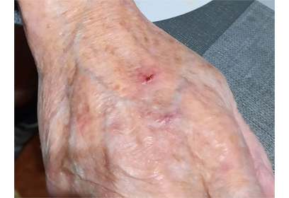 Skin Tear Behandlung Tag 17
