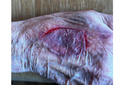 Skin Tear Typ 1 am Unterarm