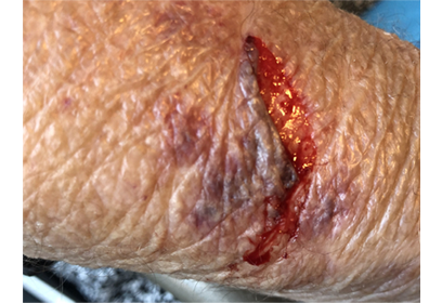 Skin Tear Typ 2 mit teilweisem Gewebeverlust