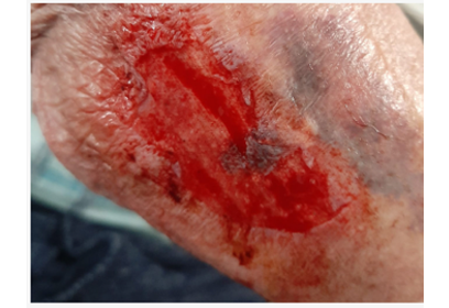 Skin Tear Typ 3 mit vollständigem Gewebeverlust