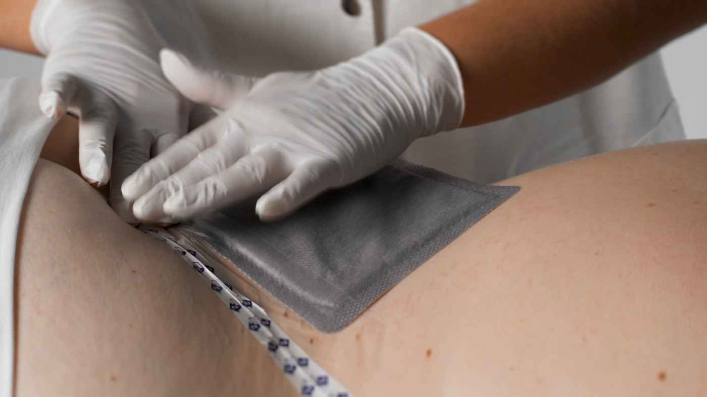 Fixierung des Biatain Superabsorber am Sakrum