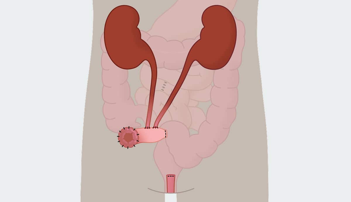 Was ist eine Urostomie?