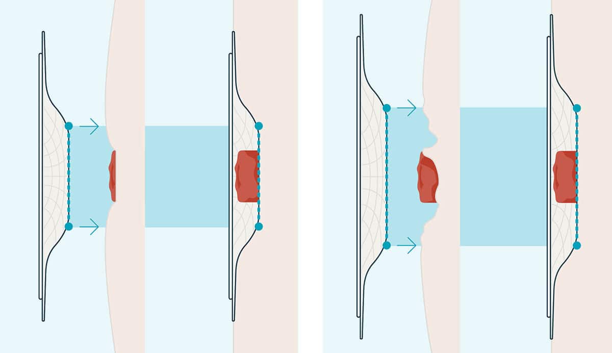 Position der Spannung ist entscheidend<sup>3</sup>