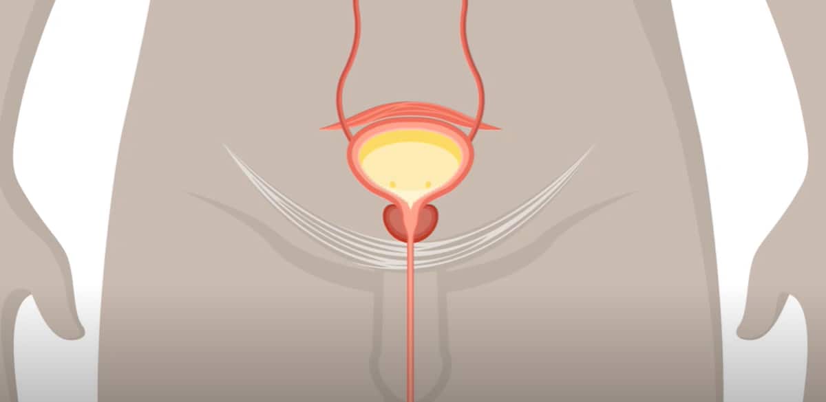 Stress Incontinence Animation Stress Incontinence