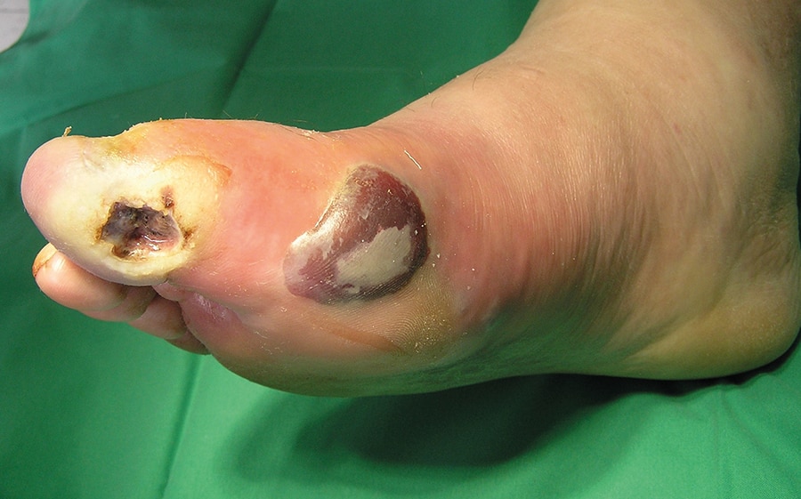 Diabetischer Fußulcus Neopathie