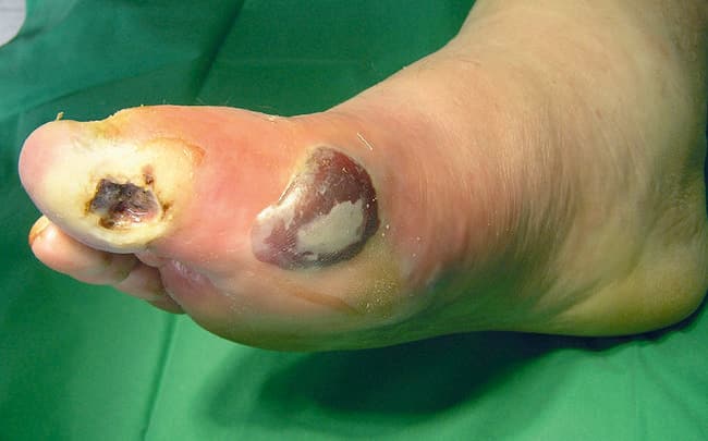 Neuropathie bei einem diabetischen Fuß sensorisch