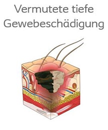 Vermutete tiefe Gewebeschädigung215x259.jpg