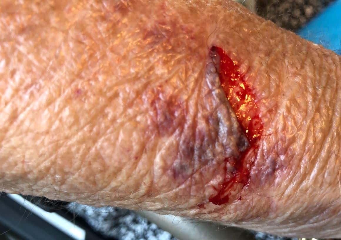 Skin Tears: Ursachen, Typen & Behandlung | Coloplast Wundversorgung