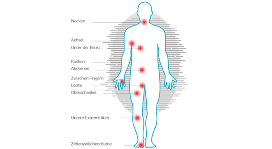 Häufige Körperstellen für Intertrigo – rot markierte Zonen wie Achseln, Leiste, Brustfalte und Zehenzwischenräume.
