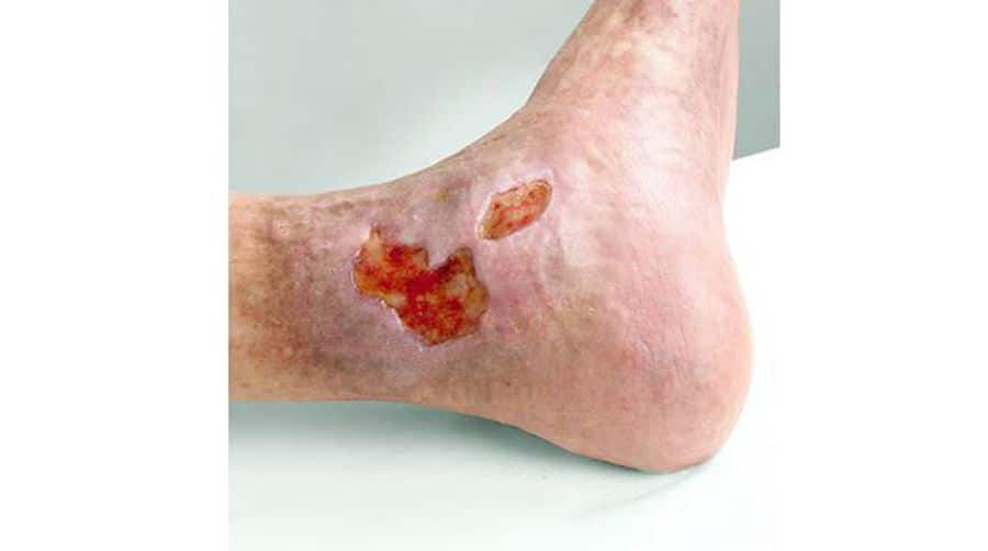 Ulcus cruris venosum – chronische Wunde am Unterschenkel durch venöse Insuffizienz mit schlechter Wundheilung