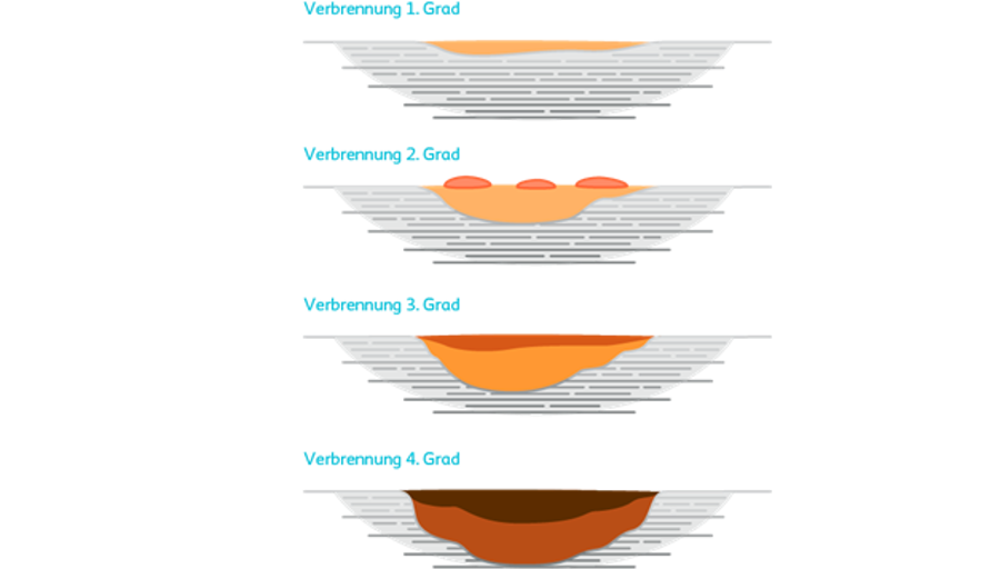 Illustration der vier Verbrennungsgrade: Von oberflächlicher Rötung bis zur tiefen Haut- und Gewebeschädigung.