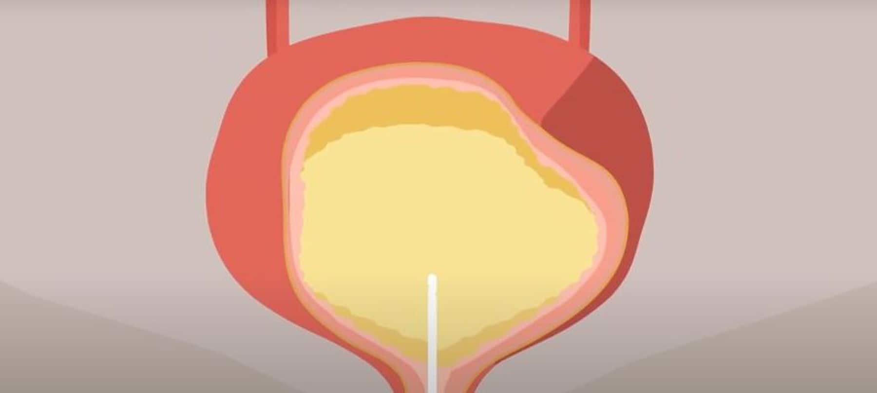 Catheter repositioning