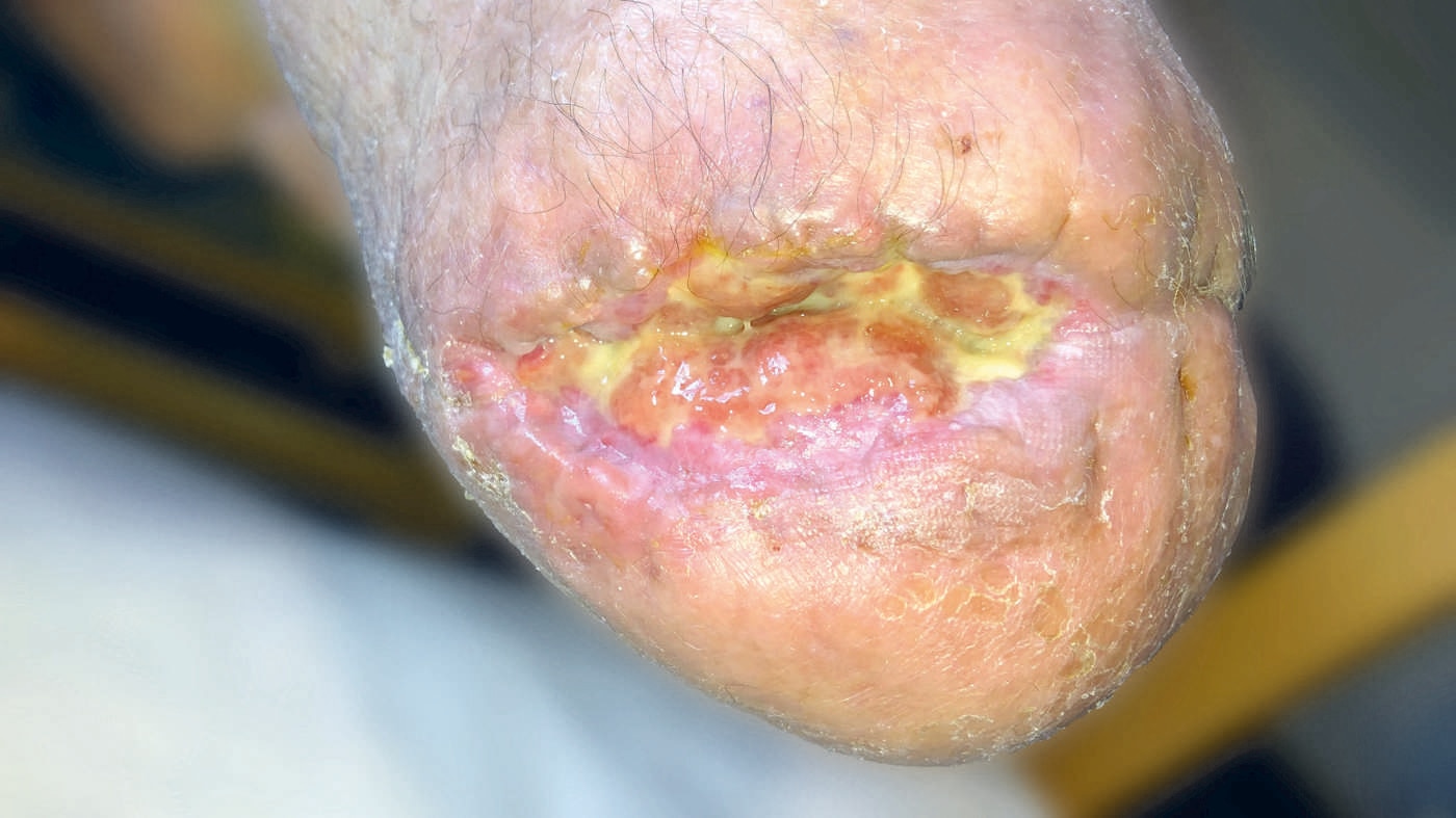 Postoperative Wundheilungsstörungen in Form einer Nahtdehiszenz