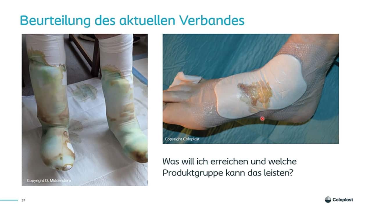 Teaser: Keimbindung & Exsudatmanagement in der Wundversorgung