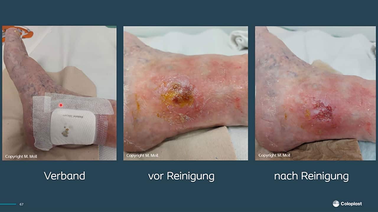Keimbindung & Exsudatmanagement in der Wundversorgung