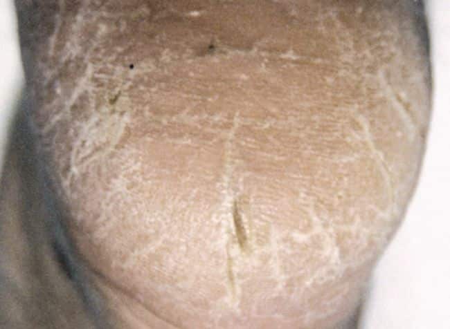 Neuropathie bei einem diabetischen Fuß autonom