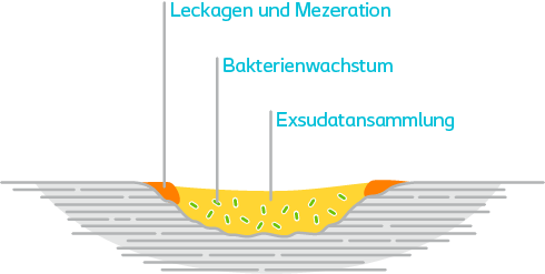 Exsudatansammlung, Bakterienwachstum und Mazeration als Folgen unzureichenden Wundexsudat-Managements.
