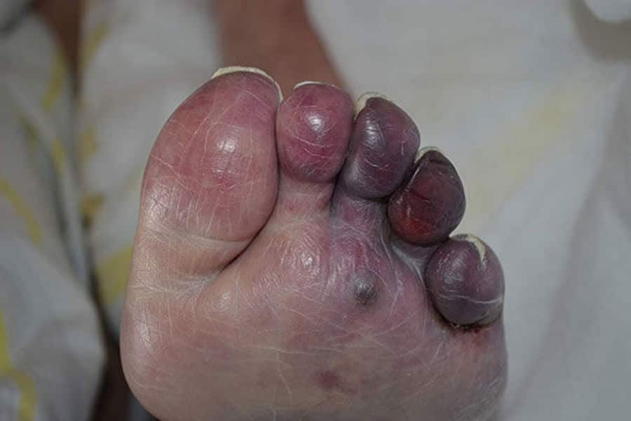 Nekrose bei Ulcus cruris arteriosum – Absterben von Zehen durch Mangeldurchblutung und arterielle Verschlusskrankheit (pAVK)