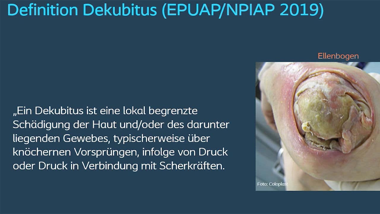 Teaser: Dekubitus muss nicht sein – Prävention und Behandlung​