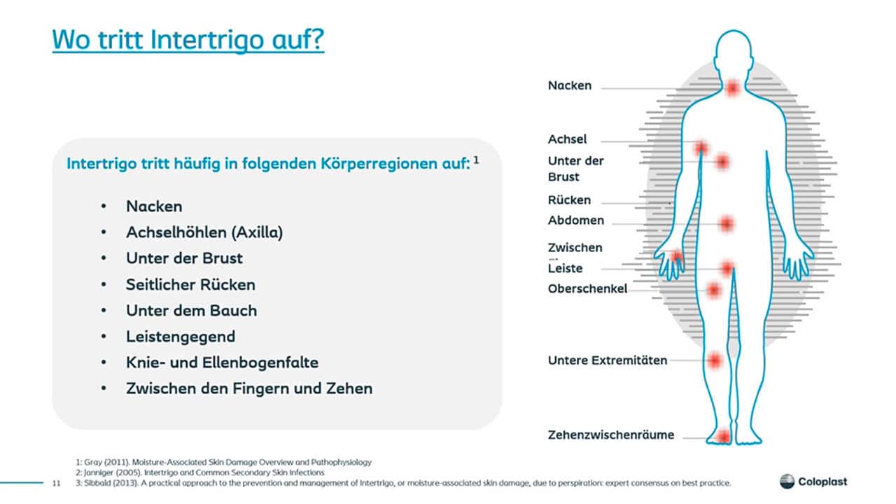 Teaser: Augen auf: Intertrigo oder IAD