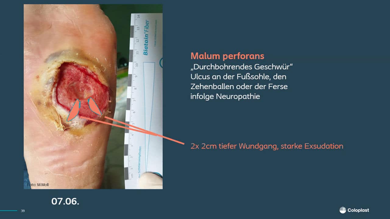 Teaser: Das diabetische Fußsyndrom