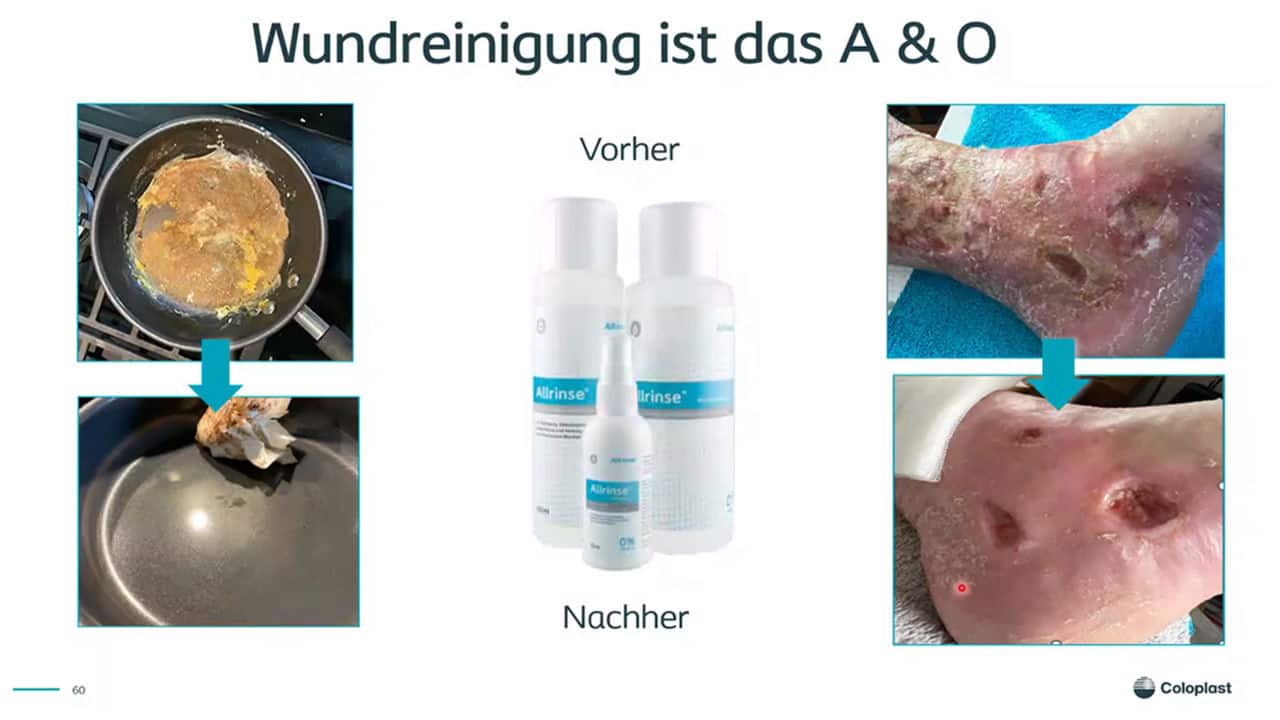 Wundphasen und Wundreinigung