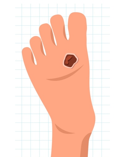 Diabetisches Fußsyndrom.PNG